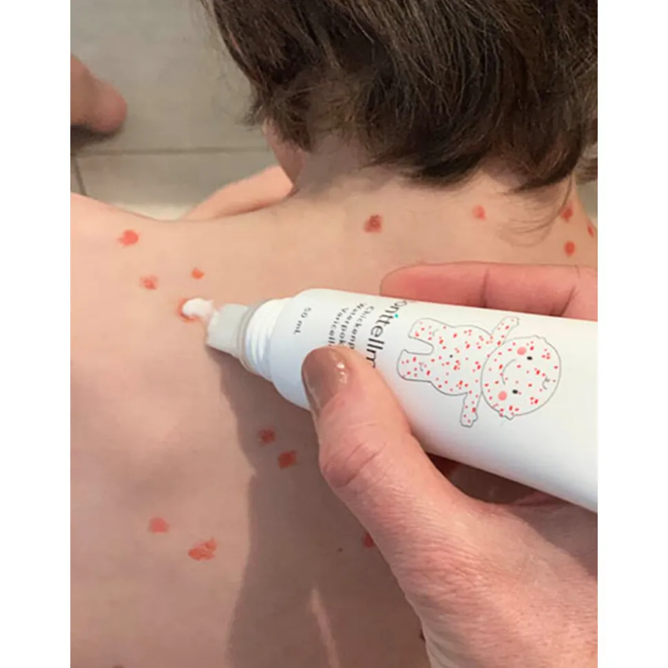 Donttellmum Waterpokken Behandeling 50 ml